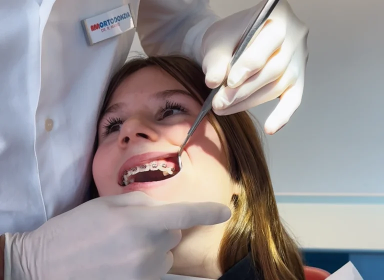 Come si applicano gli elastici dell’apparecchio